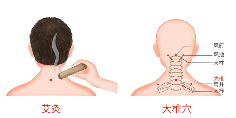 颈椎病艾灸